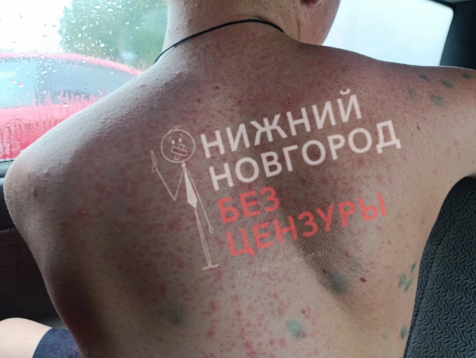 Сыпь-1.jpg