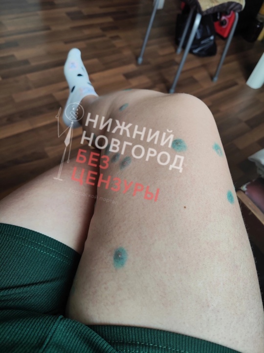 Сыпь-2.jpg