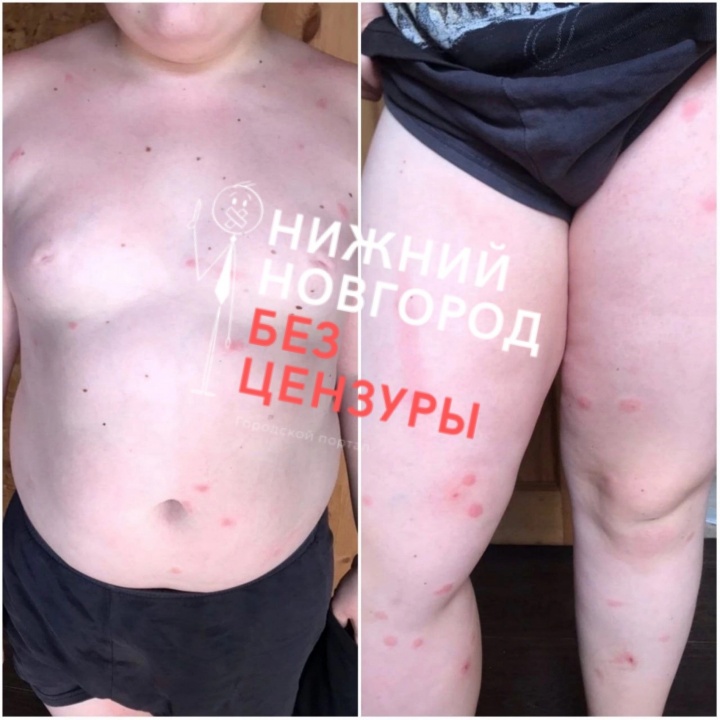 Сыпь-3.jpg