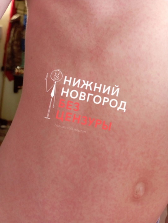 Сыпь-4.jpg
